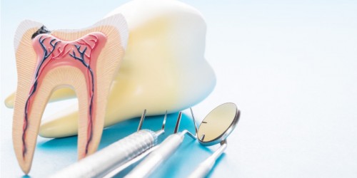 Do You Need A Root Canal Treatment Before Getting A Crown Or Bridge?